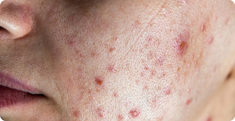 Skin Purging vs Breakout: How to Know What’s Happening to Your Skin